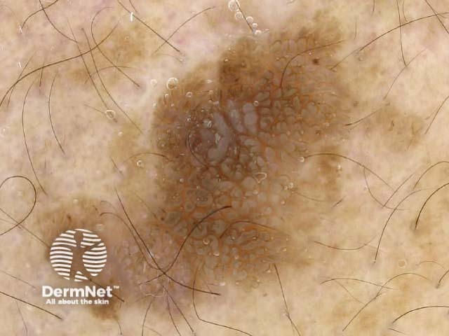 Dermoscopy Seborrhoeic Keratoses