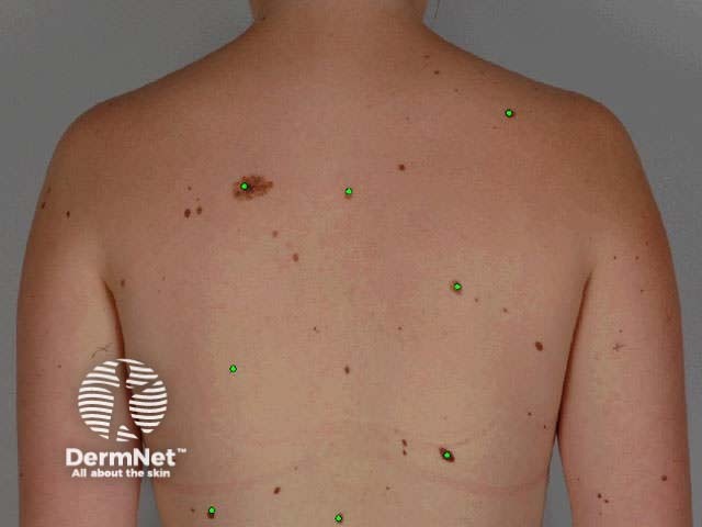 MoleMap bodyshot