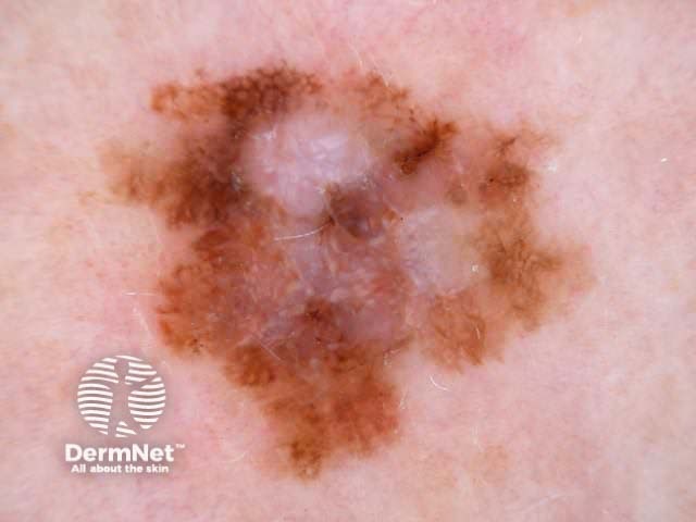 Melanoma