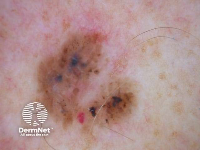 Pigmented basal cell carcinoma