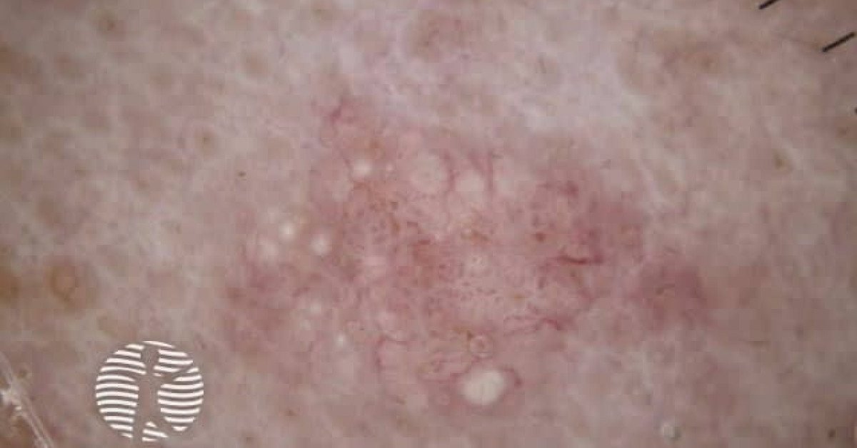 Dermatoscopy of sebaceous hyperplasia image