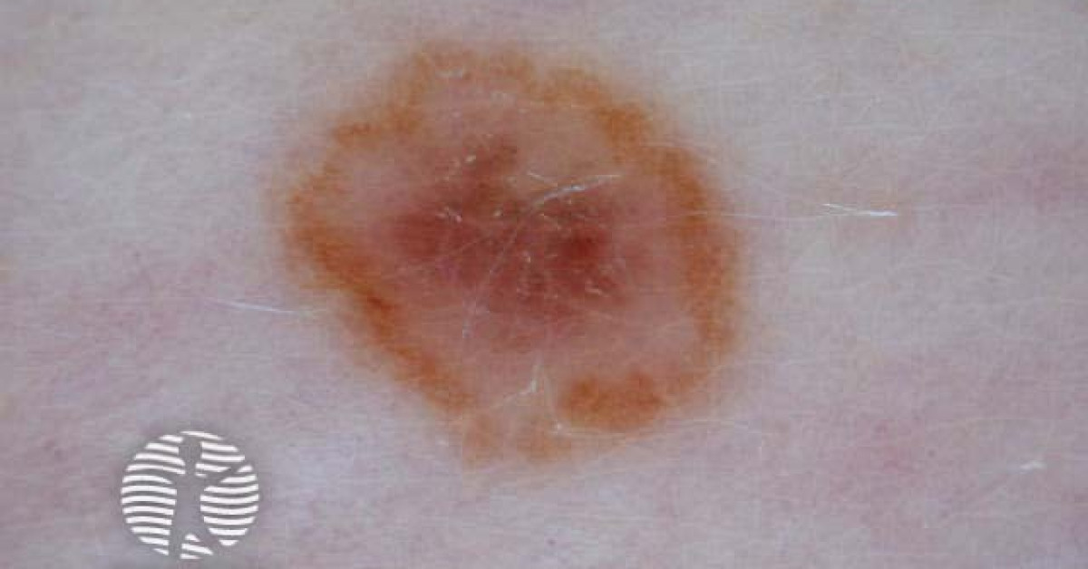 Multicompent Pattern Dermoscopy. Multicomponent pattern; concentric in cockade naevus image
