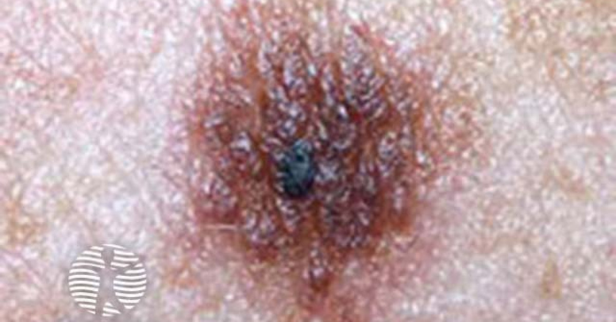 Combined naevus clinical image