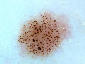 Congenital melanocytic naevus