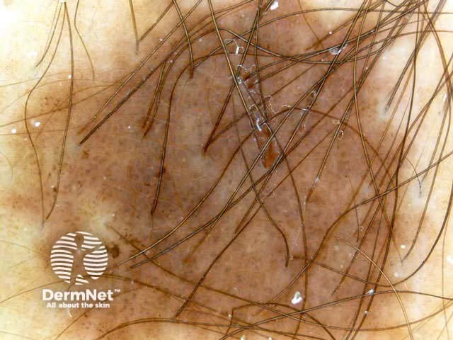 Terminal hairs