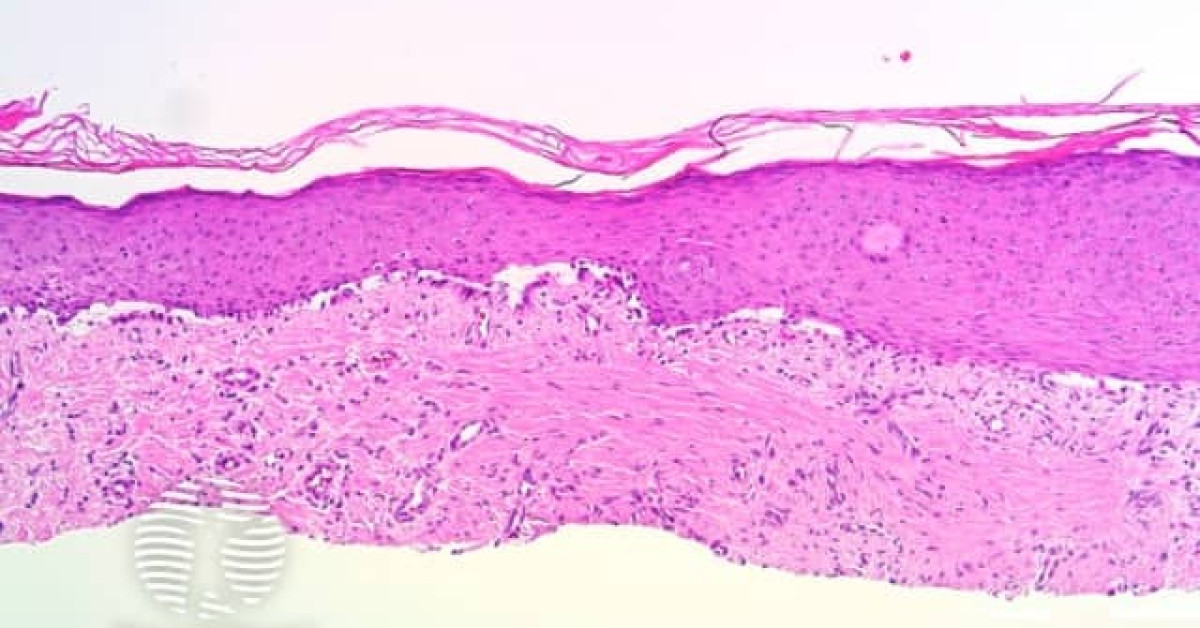 DermNet® - Histology Of Dermatofibroma Image