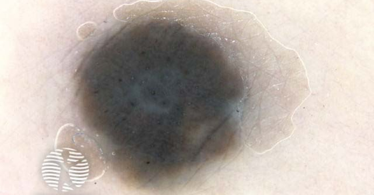 Dermoscopy. Dotted pattern image