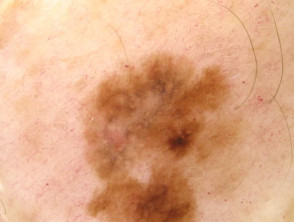 Dermoscopy. Mixed pattern; melanoma