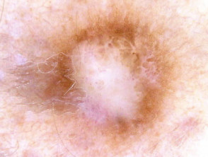 Dermoscopy. Prominent central white area: dermatofibroma