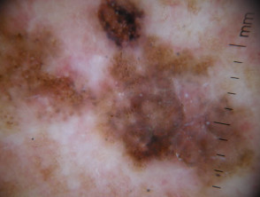CHAOS and clues in melanoma