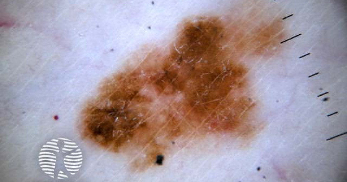 DermNet® - CHAOS and clues in melanoma image