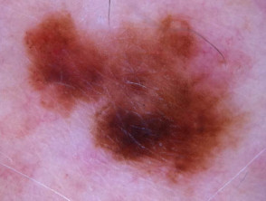 BLINCK in melanoma
