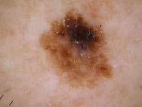  C.A.S.H. in melanoma
