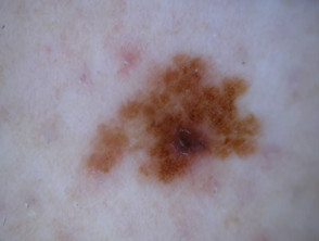  C.A.S.H. in melanoma