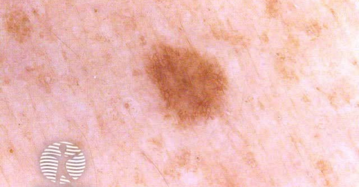 Dermoscopy image