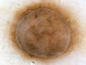 Fried-egg pattern dermoscopy