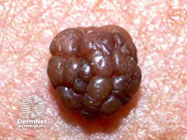 Globular pattern clinical