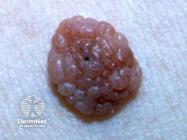 Globular pattern clinical