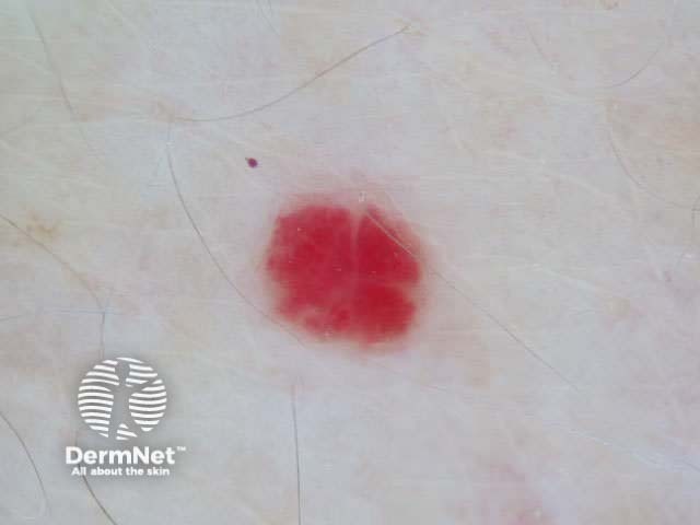 Cherry angioma