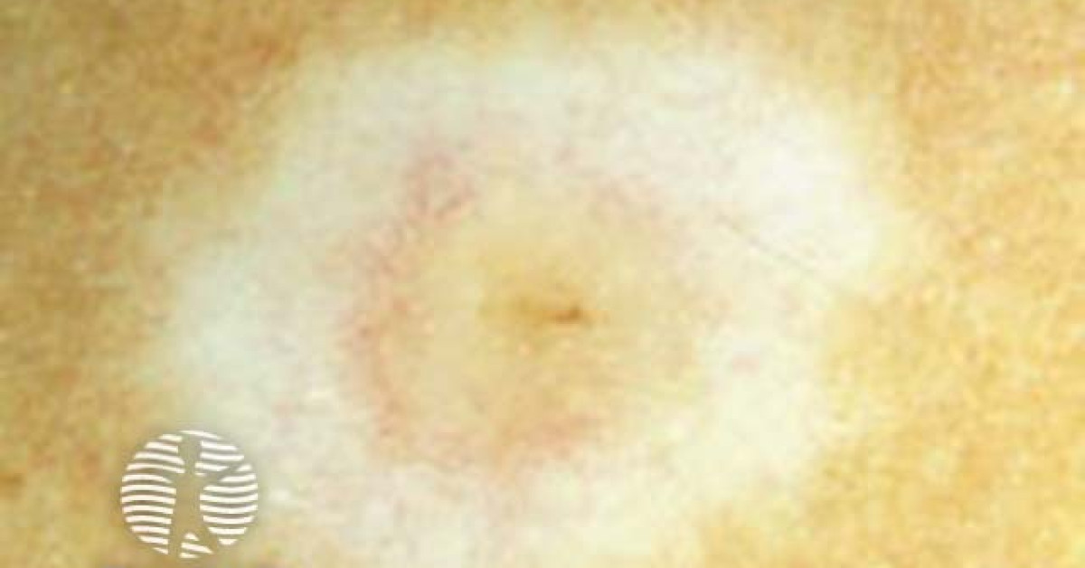 halo naevus dermoscopy image