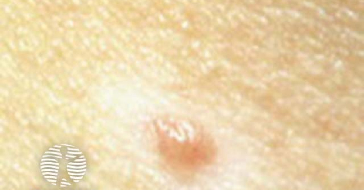 halo naevus clinical image