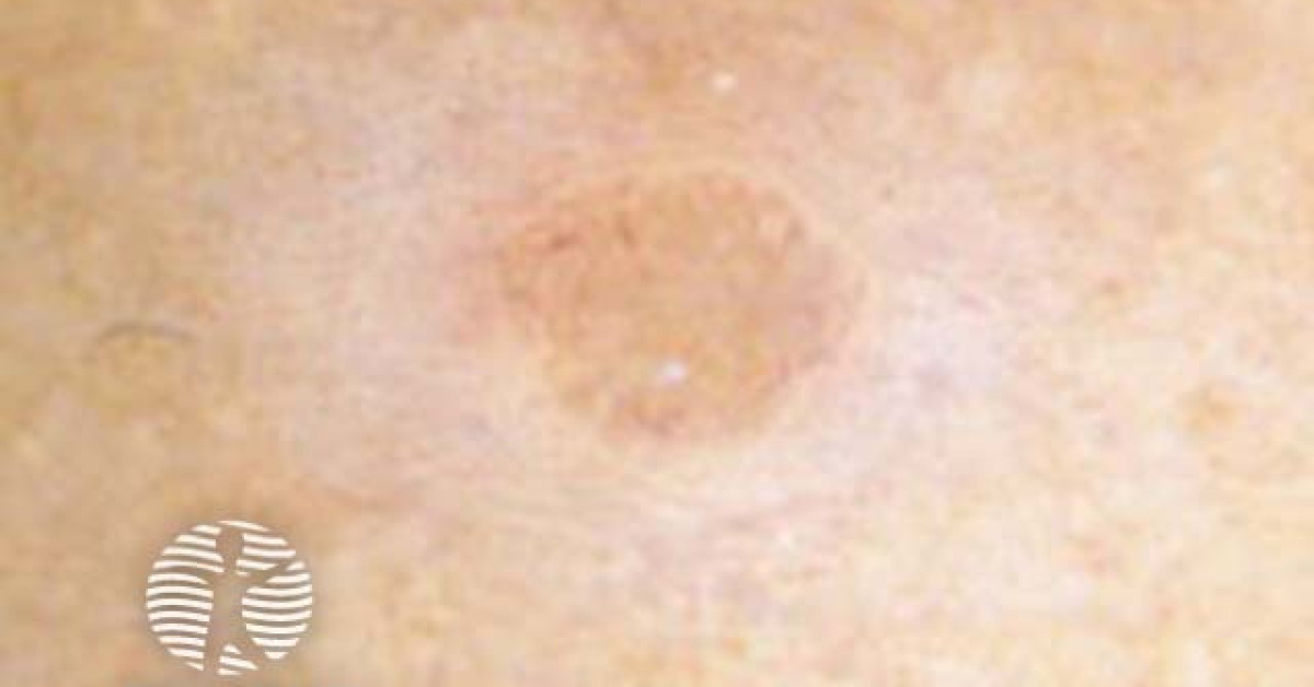 halo naevus dermoscopy image