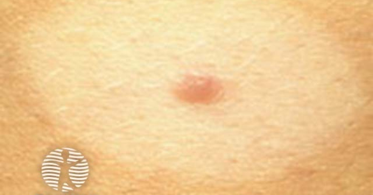 halo naevus clinical image