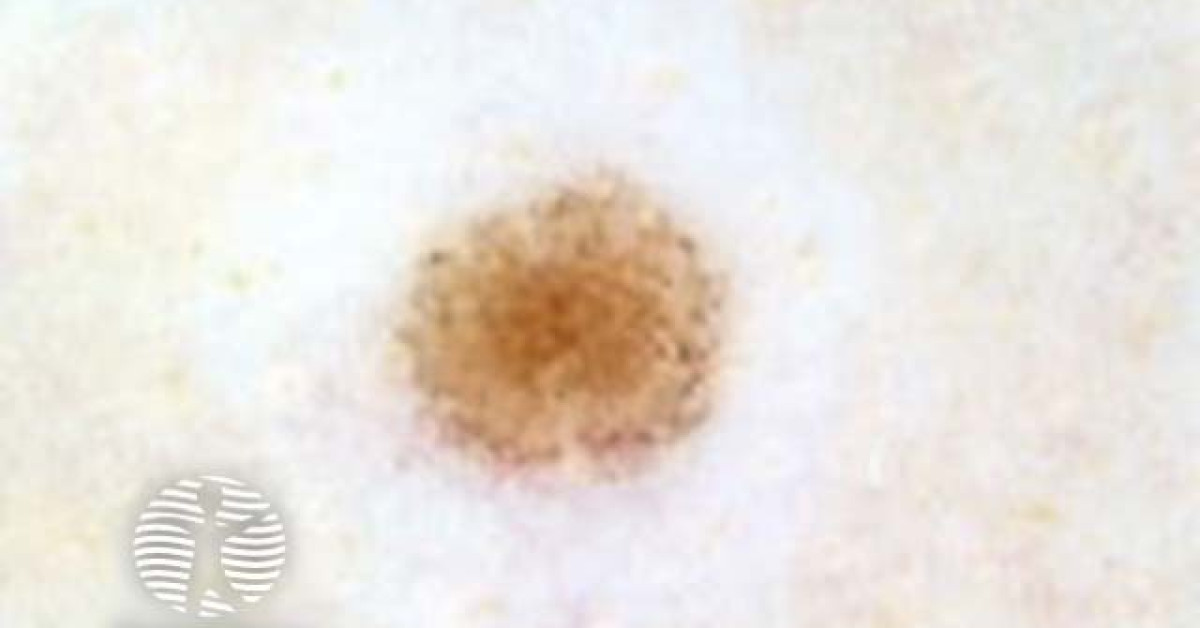 halo naevus dermoscopy image