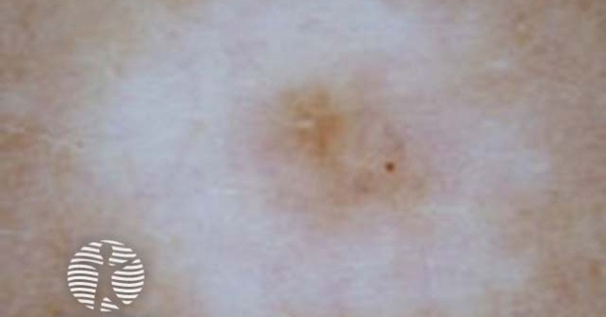 halo naevus dermoscopy image