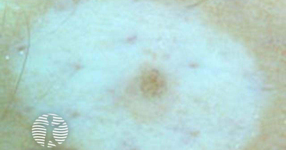 halo naevus dermoscopy image