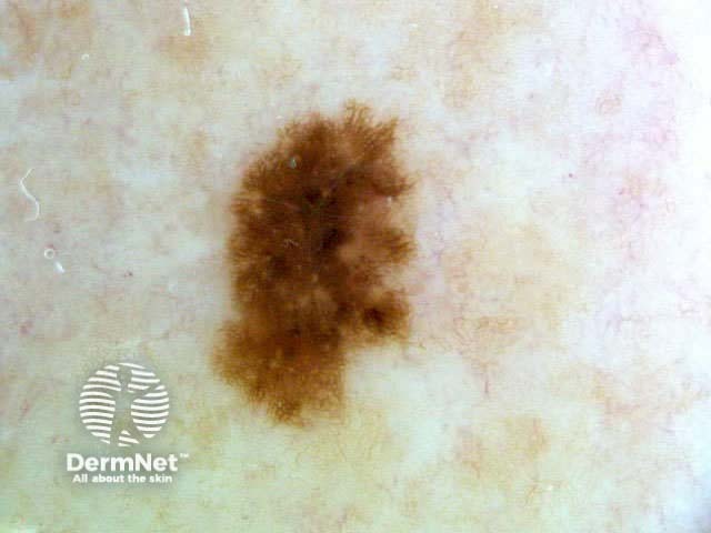 Dermoscopy Benign Melanocytic Lesions
