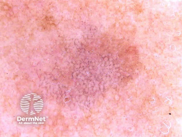 Lichenoid keratosis