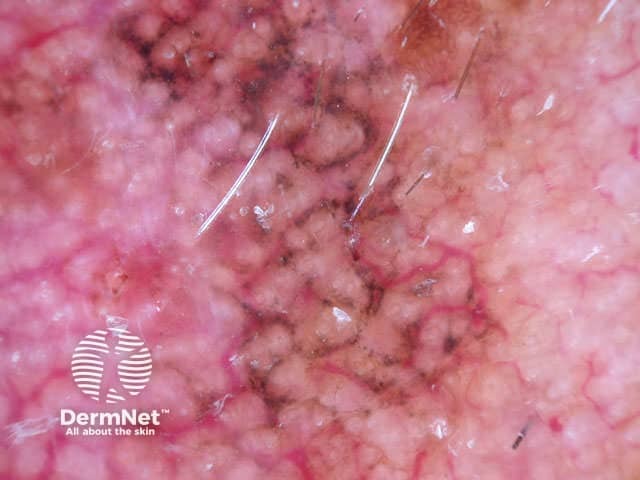 Annular granular pattern and rhomboids seen in dermoscopy of lentigo maligna