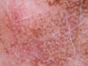 Annular granular pattern seen in dermoscopy of lentigo maligna