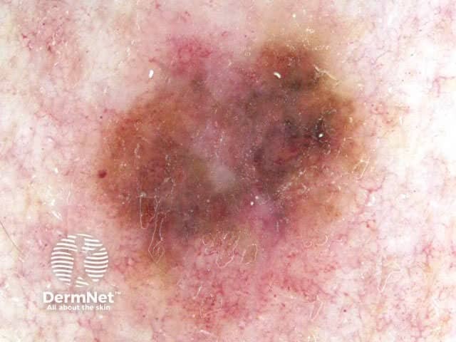 Melanoma