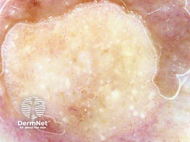 Seborrhoeic keratosis