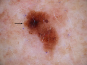 melanoma dermoscopy