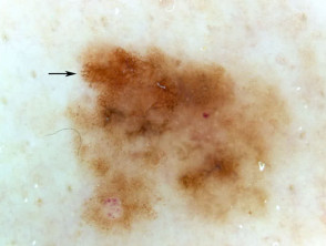 melanoma dermoscopy
