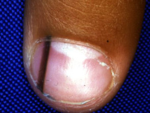 Dermoscopy. Dermoscopy of the nail | DermNet