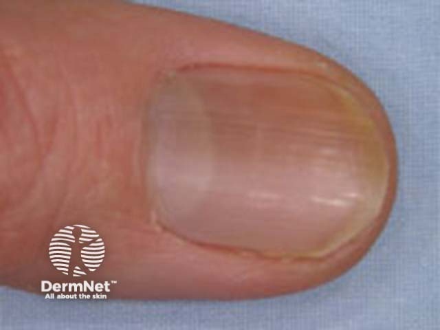 Nail naevus clinical