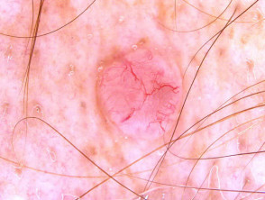 Nonpigmented basal cell carcinoma dermoscopy