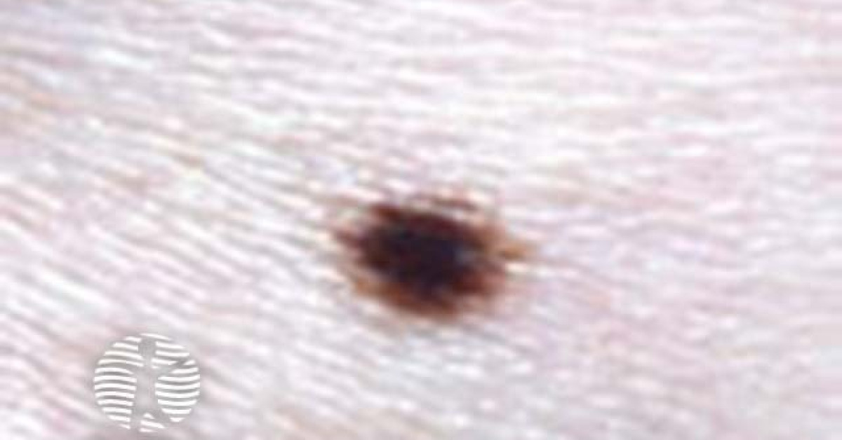 Reticular pattern clinical image