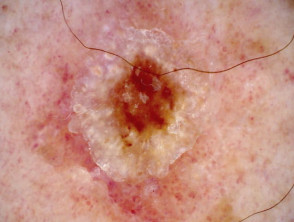 Dermoscopy of invasive squamous cell carcinoma