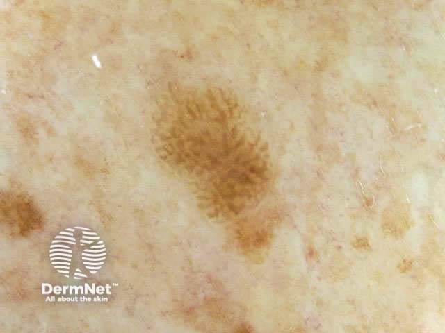 Dermoscopy Seborrhoeic Keratoses