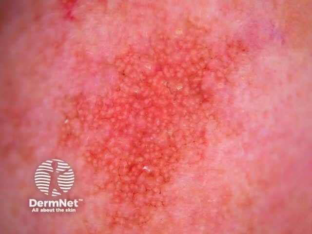Dermoscopy Squamous Cell Carcinoma