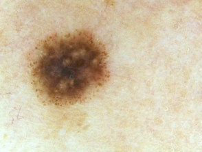 Spitz naevus (pigmented) dermoscopy