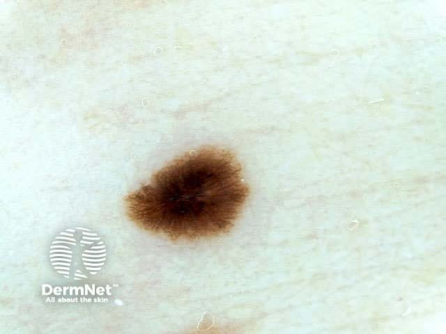 Dermoscopy Dermoscopic Features