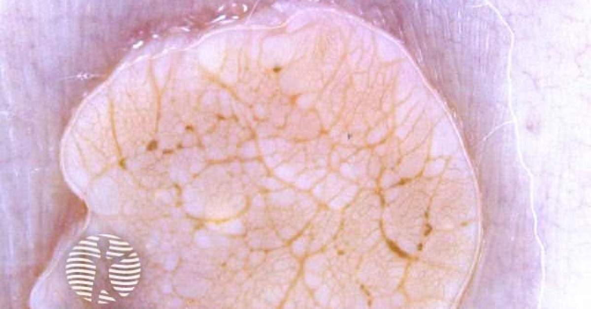 Symmetrical dermoscopic pattern image