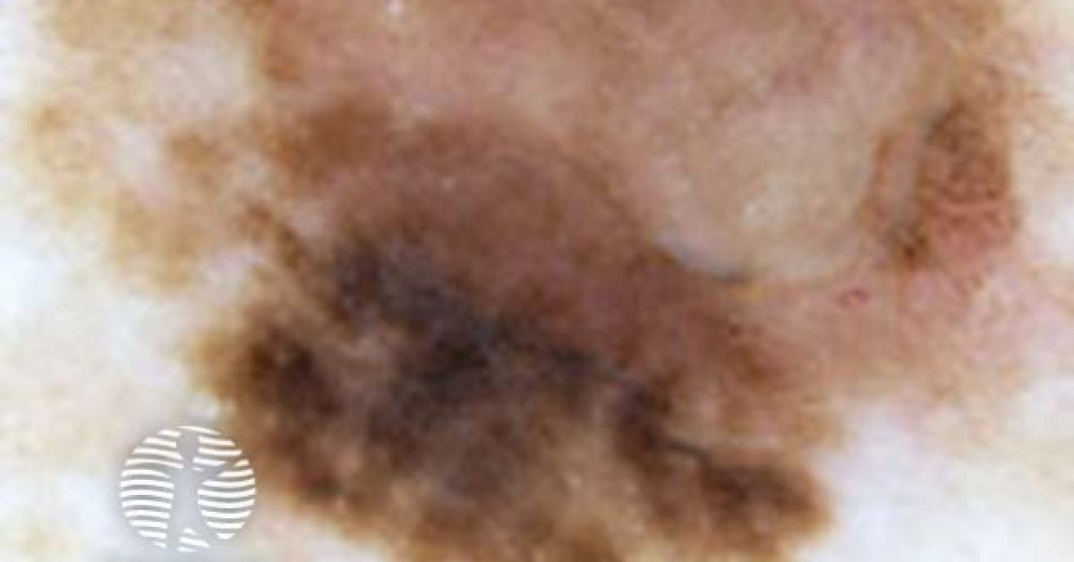 halo naevus dermoscopy image