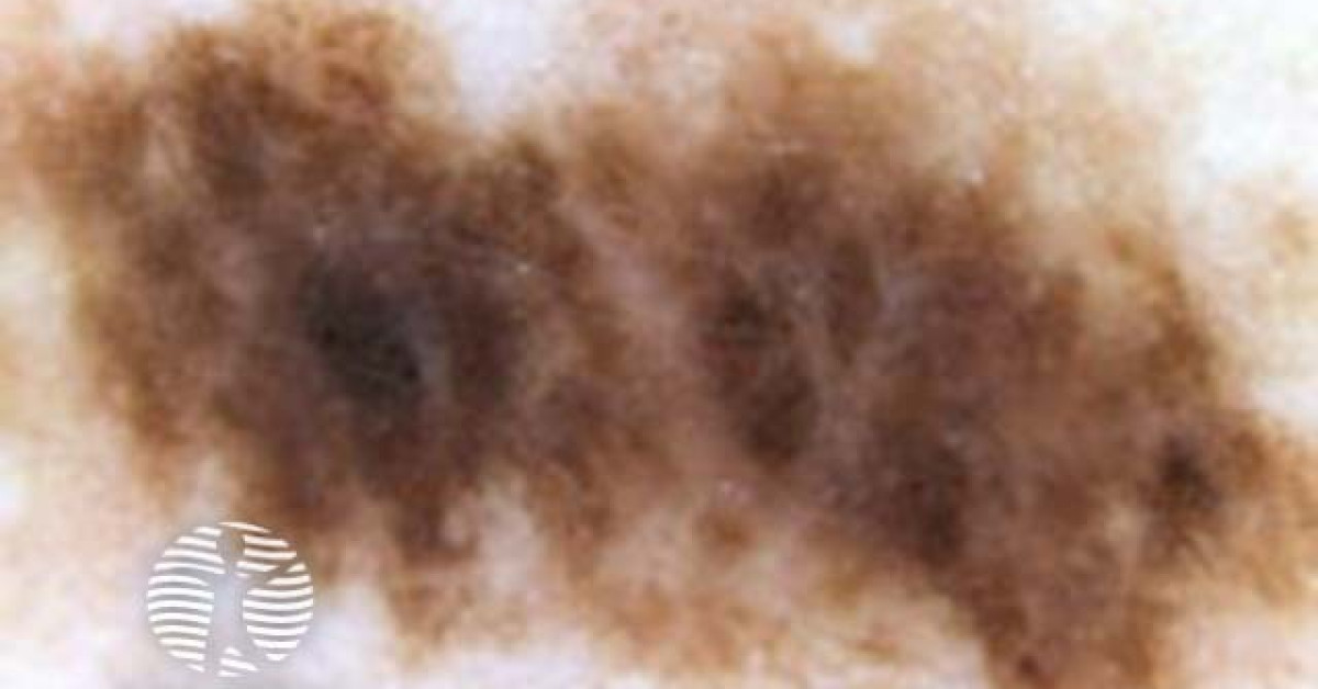 halo naevus dermoscopy image